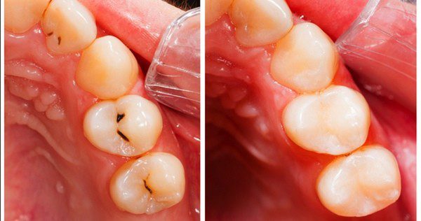 Dientes de niño con caries