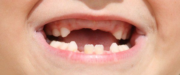 Dientes niños