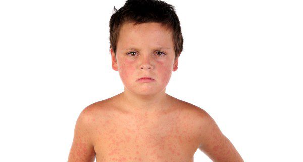 Niño con un sarpullido