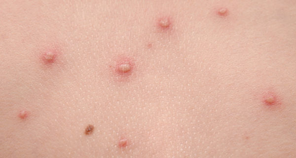 Éstas son las ampollas propias de la varicela