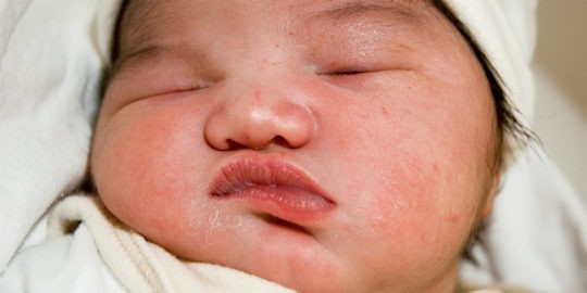Malformación del labio leporino