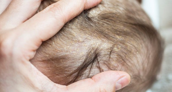 dermatitis seborreica