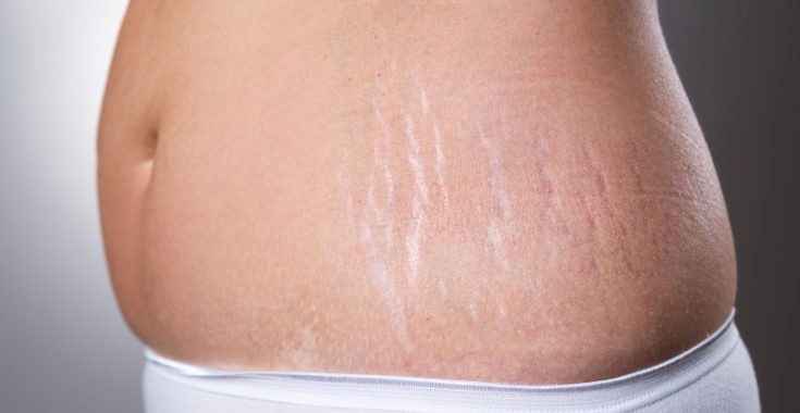 Las estrías aparecen por el repentino aumento de volumen al crecer la barriga