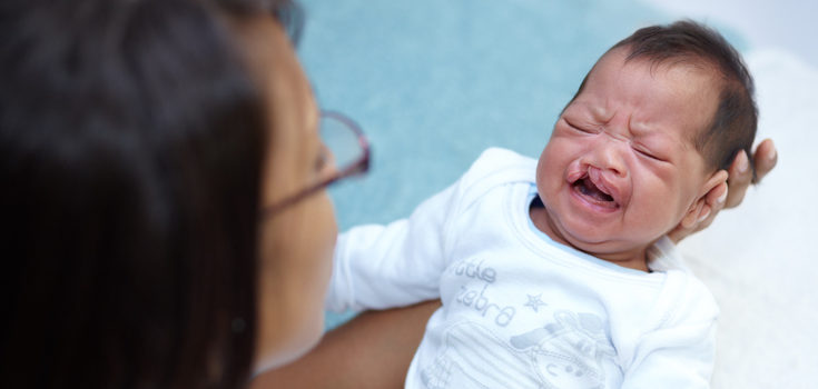 La cirugía corrige el labio leporino de los niños