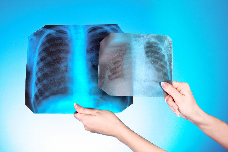 A veces se colocan placas de plomo para proteger diversas zonas del cuerpo de los rayos x