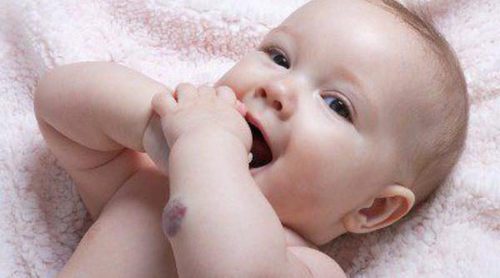 Angioma infantil, ¿qué es y cuál es su tratamiento?