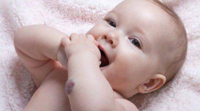 Angioma infantil, ¿qué es y cuál es su tratamiento?