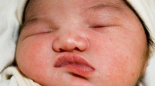 Mi hijo ha nacido con malformación del labio leporino