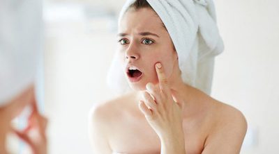 Remedios para combatir el acné en la adolescencia