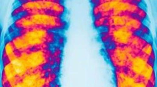 La fibrosis quística