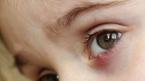3 remedios para curar un orzuelo a tus hijos