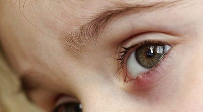 3 remedios para curar un orzuelo a tus hijos