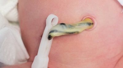 Cuánto tarda el cordón umbilical del bebé en caerse