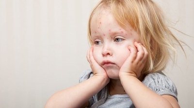 Cómo se contagia la varicela en niños