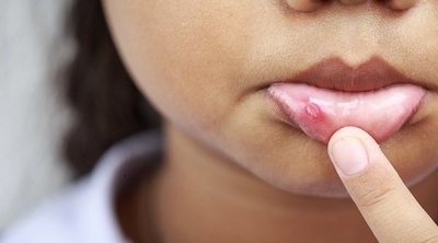 Remedios naturales para tratar el herpes en los niños