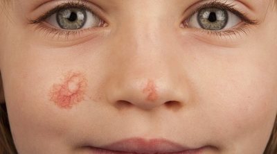 Cuándo desaparece un angioma en el bebé