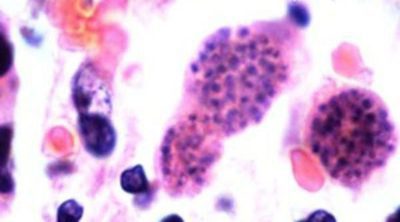La toxoplasmosis en el embarazo