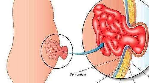 Qué es la hernia umbilical en los bebés