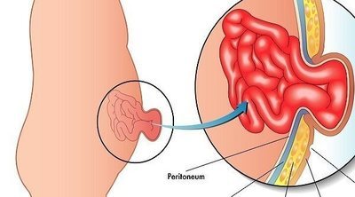 Qué es la hernia umbilical en los bebés