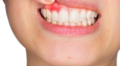 Dolor de encías en los niños, ¿qué hacer?