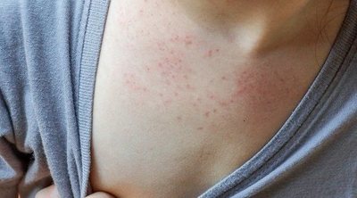 Qué son las enfermedades exantemáticas en niños