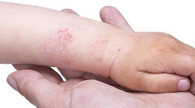 Miliaria roja en bebés y niños pequeños